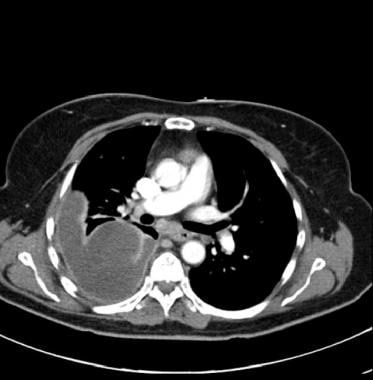 Chest CT scan with intravenous contrast in a patie