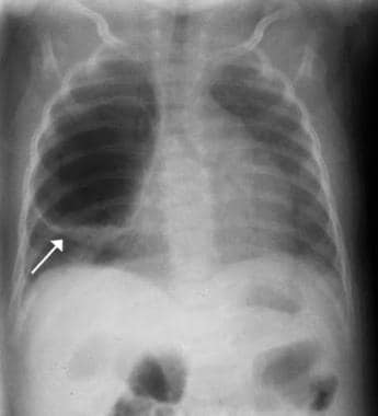 Posteroanterior chest radiograph showing large bro