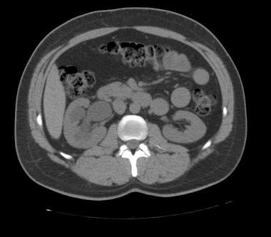 A noncontrast, axial CT image showing right-sided 