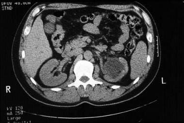 CT scan without contrast demonstrating severe left