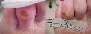 What Is a Hammertoe? - Keck Medicine of USC