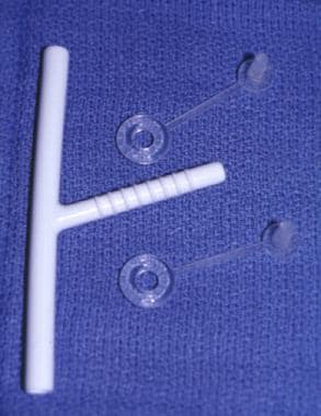 Montgomery T-tube (7 mm) stent with caps. 