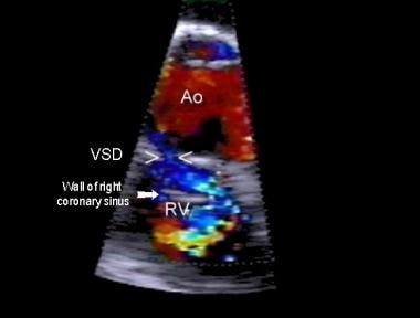 Sinus of Valsalva aneurysm. Color-flow Doppler ult