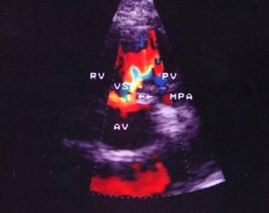 Parasternal short-axis echocardiogram view with co