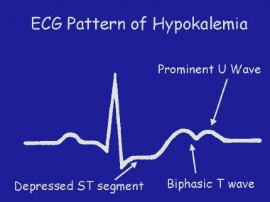 Pediatric Diabetic Ketoacidosis. A graphical repre