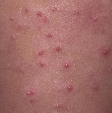 Molluscum contagiosum - Symptoms & causes - Mayo Clinic