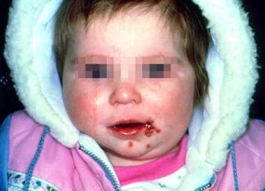 gingivostomatitis in babies