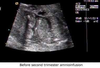 Sonogram obtained before second-trimester amnioinf