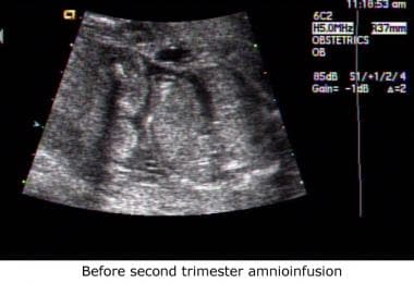 oligohydramnios potters syndrome