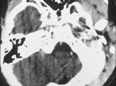 Axial CT scan of rhabdomyosarcoma in the left midd