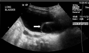 Renal/bladder ultrasound showing cystic structure 