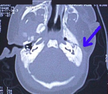 Arrow in CT scan indicates lack of ear canal (atre