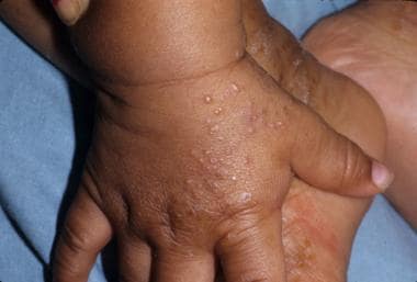 Pustules on the dorsal hands of a 1-year-old child