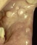 Viral Infections of the Mouth