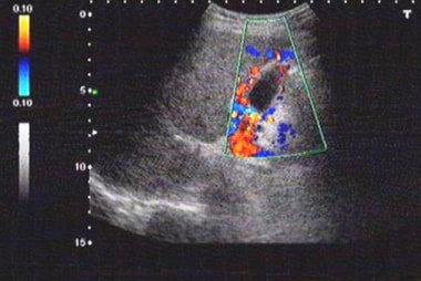 An oblique color Doppler ultrasound scan through g