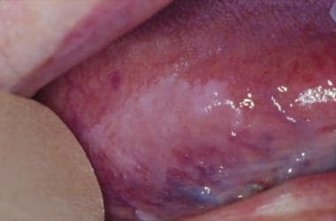 white sponge nevus gingiva