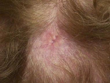 由于转移性乳房癌，Alopecia肿瘤