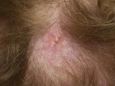 Alopecia neoplastica due to metastatic breast canc