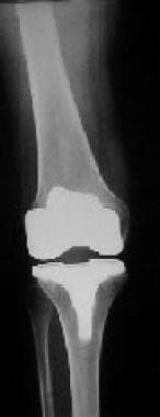 Total knee arthroplasty for medial compartment ost