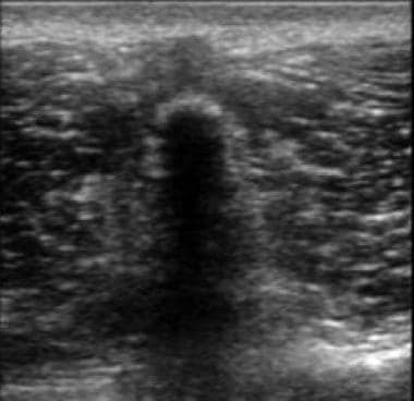 Transverse ultrasound image of the lumbar spine de