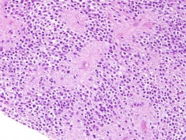 Clear cell ependymoma. Note the vague perivascular