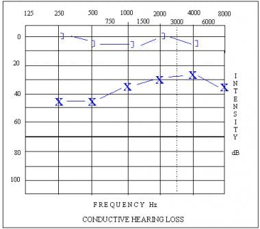 Audiogram depicting a mild rising conductive heari