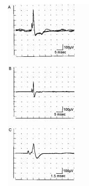 肌电图(EMG)对运动负荷的评价