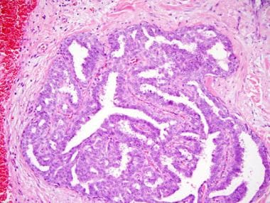 Duct papillomatosis pathology outlines - Ductal papilloma outlines