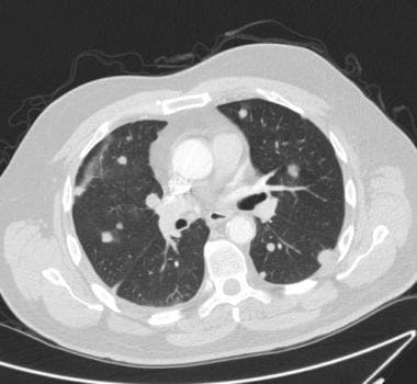 CT scan of chest in the same patient as preceding 