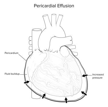 Pericardial effusion. 