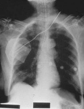 Radiograph depicting right main-stem intubation th