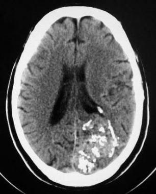 CT scan of the head showing a left occipital arter