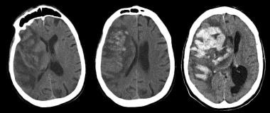 Noncontrast CT (left) obtained after this 75-year-