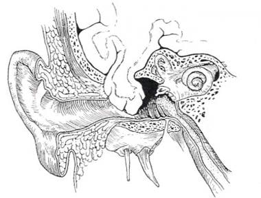 Artist's rendering of a tegmen tympani bone defect