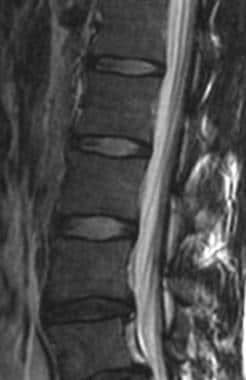 Sagittal T2-weighted imaging of lumbosacral spine 
