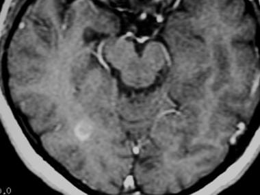 Axial T1-weighted, gadolinium-enhanced MRI in a pa