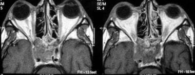 Axial contrast-enhanced T1-weighted MRIs show a me