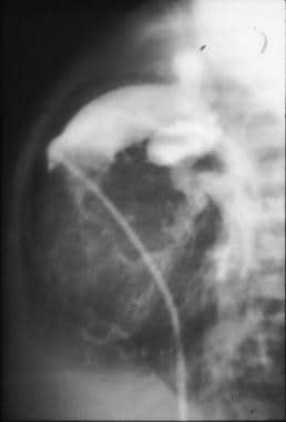 Lateral angiocardiogram in an infant with truncus 