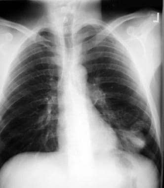 Chest radiograph from a patient with pulmonary bla