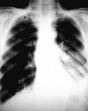 Chest radiograph shows rib fractures and a left-si