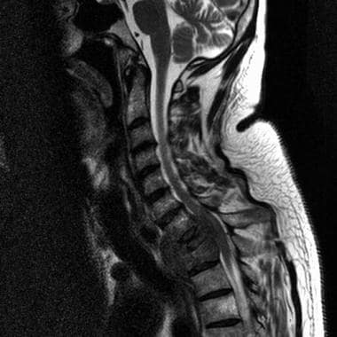 pancoast tumor neck