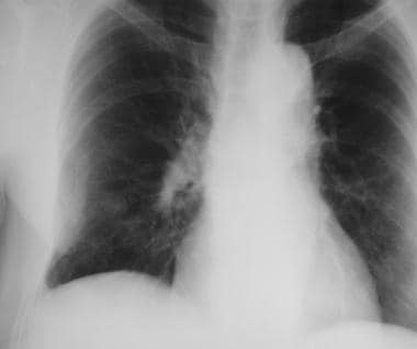 A solitary pulmonary nodule along the rib can be a