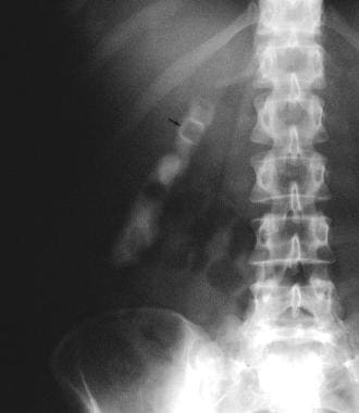 This plain abdominal radiograph shows milk-of-calc