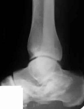 Calcaneus, fractures. Rowe type V, intra-articular