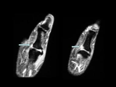 STIR sequence coronal MRI of the thumb showing a m