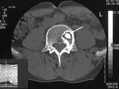Transaxial CT scan in a 52-year-old man who had a 