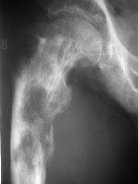 Anteroposterior (AP) radiograph of the proximal fe