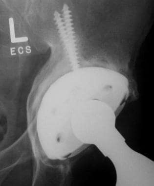 Image from a patient who had a cemented total hip 