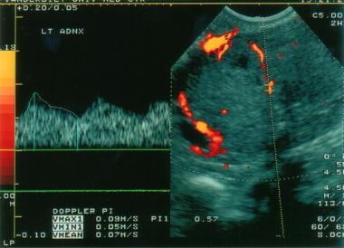 Transvaginal, color Doppler ultrasonogram shows a 