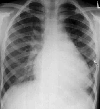 Chest radiograph in a 3-year-old with Down syndrom